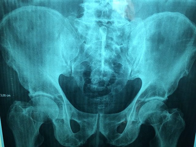 hip replacement