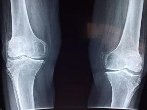 Failed knee replacement x-ray.