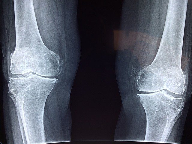 Failed knee replacement x-ray.