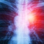 X-ray shows anomaly on lungs