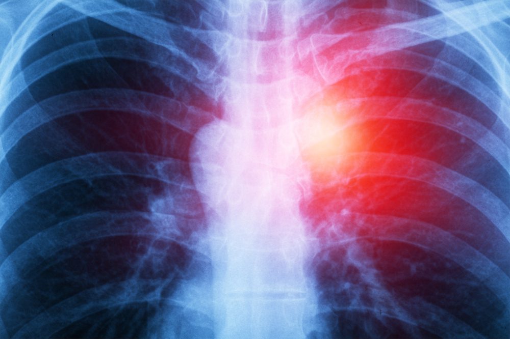 X-ray shows anomaly on lungs