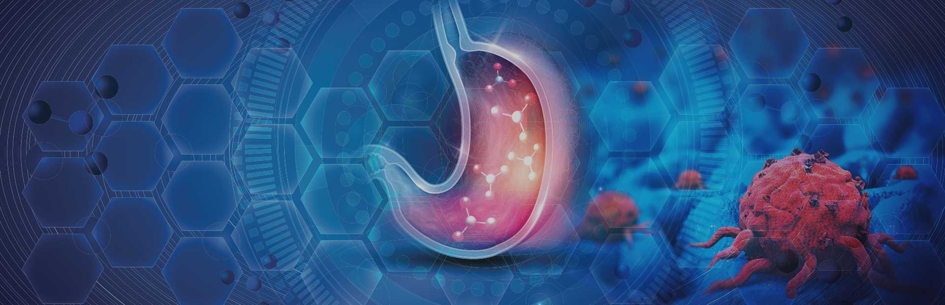 Computer Generated image of stomach and disease